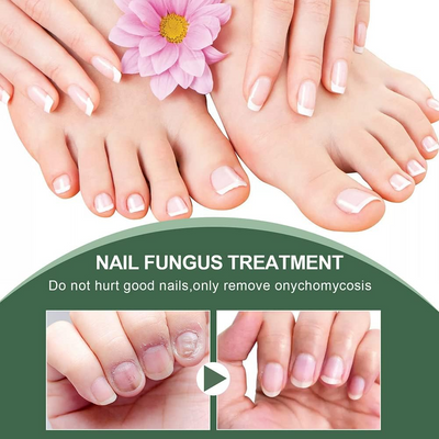 FungiFreeze™ — Unlock Clear, Healthy Nails and Step Out with Confidence