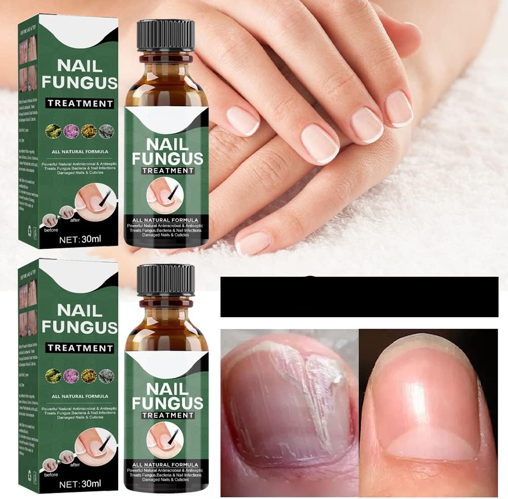 FungiFreeze™ — Unlock Clear, Healthy Nails and Step Out with Confidence